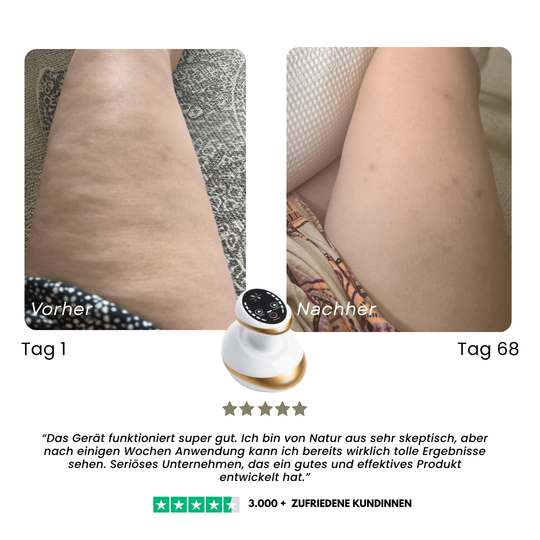 CelluSmooth™ - Anti-Cellulite Massagegerät